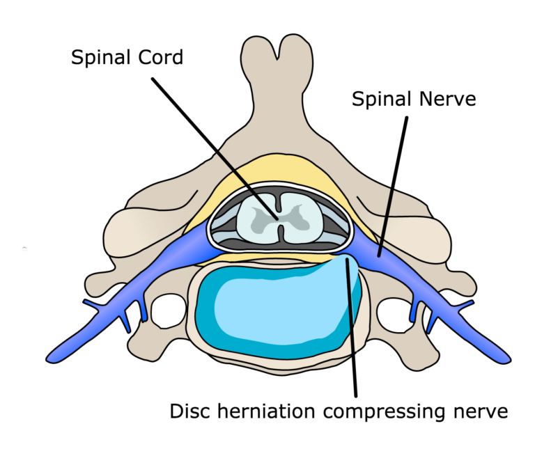 Part 2: Are You Sure it's Carpal Tunnel? | Phipps Soft Tissue and Spine