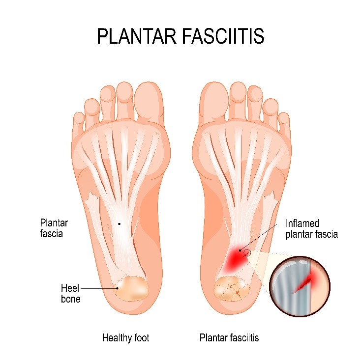 Inflammation on bottom 2025 of foot